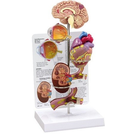 GPI ANATOMICAL Anatomical Model - Hypertension 4000